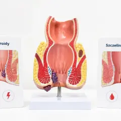 Model anatomiczny odbytu z hemoroidami i szczeliną. Ból odbytu w ciąży to częsty problem.