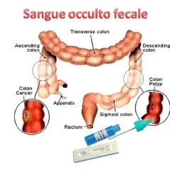 Illustrazione del colon con indicazioni su cancro, polipi e test per sangue occulto nelle feci.
