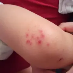 Lesioni cutanee rosse e pruriginose su un braccio di bambino, indicative di impetigine.