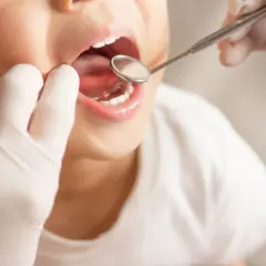 Bambino con bocca aperta esaminata da un dentista con specchietto. Si valuta la possibile ipomineralizzazione dello smalto.