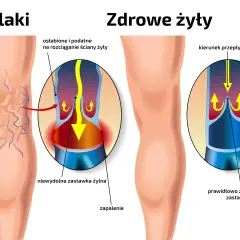 Ilustracja porównująca żylaki z zdrowymi żyłami, pokazująca nieprawidłowe działanie zastawek żylnych.