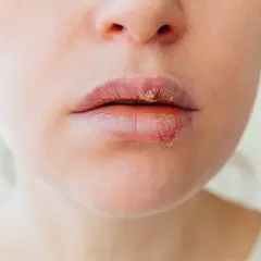 Labbra con lesioni erpetiche. Le vescicole e le croste indicano la fase attiva, ma quanto dura l'herpes?