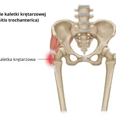 Zapalenie kaletki krętarza większego – ilustracja anatomiczna miednicy i uda z zaznaczonym bolącym obszarem.