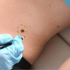 Rysowanie obrysu znamienia przed wycięciem czerniaka i co dalej. Lekarz w niebieskiej rękawiczce zaznacza skórę.