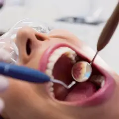Zabieg piaskowania zębów w gabinecie stomatologicznym. Dentysta używa lusterka i piaskarki do oczyszczenia uzębienia.