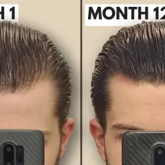 Comparaison avant/après 12 mois : le derma roller a visiblement densifié la chevelure et réduit la perte de cheveux sur le front.
