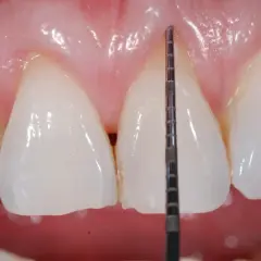 Misurazione della profondità gengivale con sonda parodontale. La recessione gengivale è un problema da non sottovalutare.