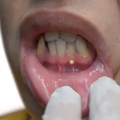 Pequeña protuberancia amarilla en la encía, posiblemente un quiste gingival, examinada con guantes.