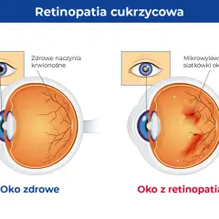 Porównanie zdrowego oka z naczyniami krwionośnymi siatkówki i oka z retinopatią cukrzycową, gdzie widoczne są mikrowylewy.