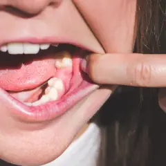 Ból po ósemce: Kiedy minie? Normalne objawy czy suchy zębodół?