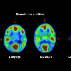 Imagerie cérébrale montrant l'activité lors du repos, du langage, de la musique et des deux. La musique révèle une zone sensible en musique.