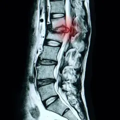 MRT-Aufnahme der Lendenwirbelsäule zeigt einen Bandscheibenvorfall (protrusion lws) mit Rötung im betroffenen Bereich.