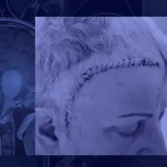 Widok rezonansu magnetycznego mózgu z guzem przysadki i głowa pacjenta po operacji.