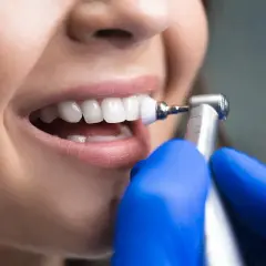 Denti bianchi e sani dopo la detartrasi ultrasuoni. Un dentista con guanti blu pulisce i denti con uno strumento rotante.