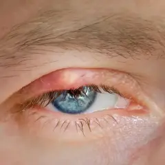 Żółtawy guzek na powiece, przypominający xanthelasma, obok niebieskiego oka.