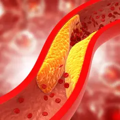 Miażdżyca aorty piersiowej objawy - poznaj niebezpieczne symptomy