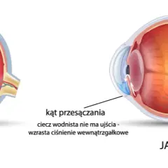 Jak sprawdzić czy mam jaskrę? Objawy i ważne badania, które ratują wzrok