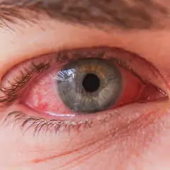 Œil rouge et irrité, signe de conjonctivite. Un traitement est nécessaire pour soulager l'inflammation.