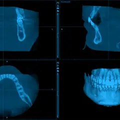 Tomografia zębów cena: szczegółowy obraz szczęki i żuchwy w trzech projekcjach, w tym widok 3D.