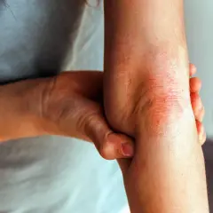 Armbeuge mit geröteter, schuppiger Haut, die stark juckt, typisch für Neurodermitis.
