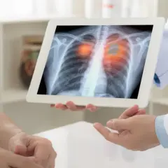Lekarz pokazuje pacjentowi zdjęcie RTG płuc z zaznaczonymi zmianami, sugerując odma płucna.