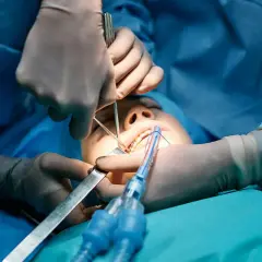 Procedimiento dental con anestesia general para extracción de muelas del juicio. Cirujanos operan la boca de un paciente.