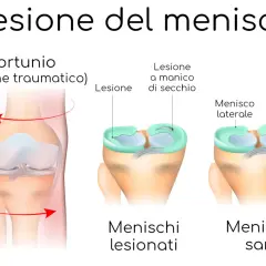 Illustrazione di un ginocchio con menisco lesionato a causa di un infortunio da rotazione. Confronto tra menischi sani e lesionati.
