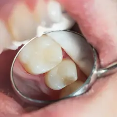 Stomatolog bada zęby, szukając próchnicy ukrytej. Widać fragment jamy ustnej, zęby i lusterko dentystyczne.