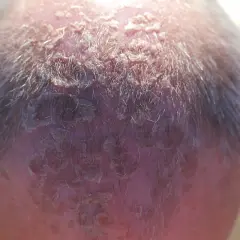 Kopfhaut mit schuppiger Haut, die auf einen starken Sonnenbrand hindeutet.