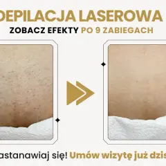 Porównanie skóry przed i po depilacji laserowej bikini.
