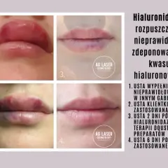Niezadowolenie po kwasie? Jak przyspieszyć wchłanianie i hialuronidaza