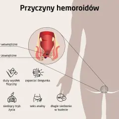 Przyczyny hemoroidów: ciąża, wysiłek fizyczny, zaparcia, biegunka, nieprawidłowe odżywianie, siedzący tryb życia, seks analny, długie siedzenie w toalecie.