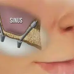 Illustrazione di un sinus lift: due impianti dentali inseriti nell'osso mascellare superiore, vicino al seno mascellare.