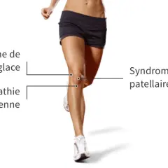 Jambes d'une coureuse, illustrant le syndrome de l'essuie-glace et la tendinopathie rotulienne, causant une douleur au genou externe.