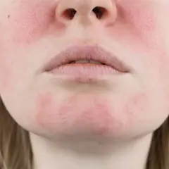 Primo piano del viso di una donna con pelle irritata e arrossata sulle guance e sul mento.