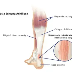 Anatomia łydki z zaznaczonym ścięgnem Achillesa, mięśniami i kością piętową. Ilustracja pokazuje degenerację ścięgna, która może powodować ból nog.