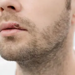 Czy z opryszczką można iść do dentysty? Ważne zasady bezpieczeństwa