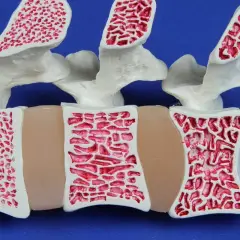 Model kręgosłupa z widoczną gąbczastą strukturą kości. Czy osteopenia może się cofnąć? Tak, przy odpowiednim leczeniu i stylu życia.
