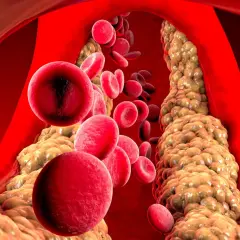Czerwone krwinki przepływające przez zatkane cholesterolem naczynie krwionośne.
