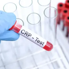 Ręka w niebieskiej rękawiczce trzyma probówkę z napisem "CRP - Test". To badanie pomaga ocenić stan zapalny w organizmie.