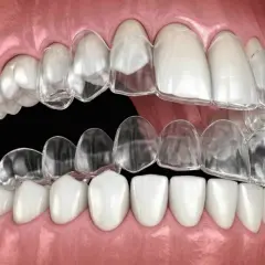 Przezroczyste nakładki Invisalign na zębach, pokazujące proces prostowania zgryzu.