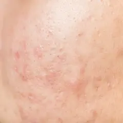 Gros plan sur une peau présentant des rougeurs et des imperfections, illustrant la cause de l'acné sur le visage.