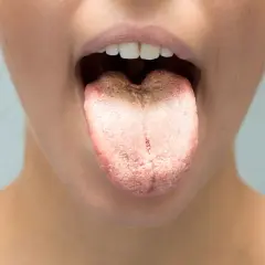Lingua con patina biancastra e filamenti bianchi in bocca, segno di possibile infezione fungina.