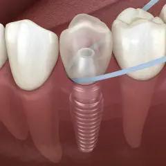 Filo interdentale che pulisce attorno a un impianto dentale. È importante prendersi cura dell'igiene orale, anche se si possono lavare i denti prima di un intervento.
