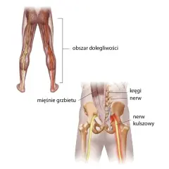 Anatomia bólu w dolnej części pleców i nogi, ilustrująca ucisk na nerw kulszowy, który powoduje objawy **sciatica po polsku**.