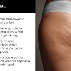 Cellulit na udach: Skuteczne sposoby na gładką skórę (Dieta, Ćwiczenia)