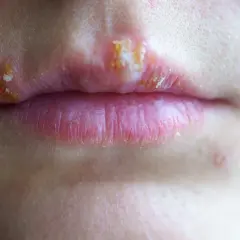 Labios con ampollas y costras, indicativo de herpes labial contagio.