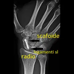 Radiografia del polso con vite nel scafoide mano, evidenziati radio e legamenti.