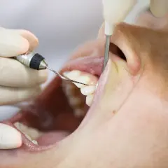 Un periodoncista que es, examina la salud de las encías y dientes con instrumental dental.