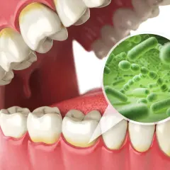Ingrandimento del microbiota orale: batteri verdi su sfondo verde, con denti ingialliti in primo piano.